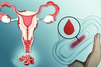 Когда цикл выходит из равновесия: как лечат тяжелые менструальные кровотечения без органической патологии